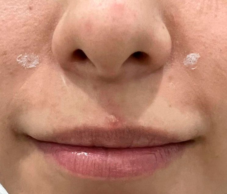 Toxina Botulínica